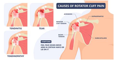 Rotator Cuff Injury & Treatment Options | Advanced Surgery Center