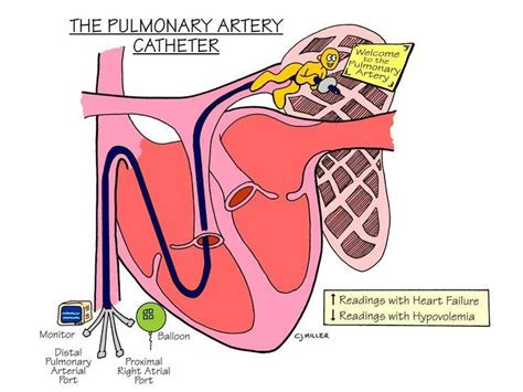 Pulmonary artery catheter Intervention - StudyPK