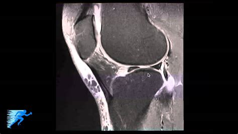 Meniscal Tear Knee Mri