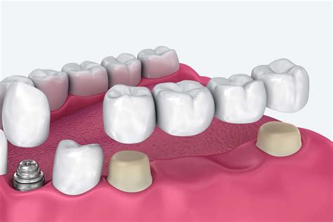 The Pros & Cons of Dental Implants and Dental Bridges