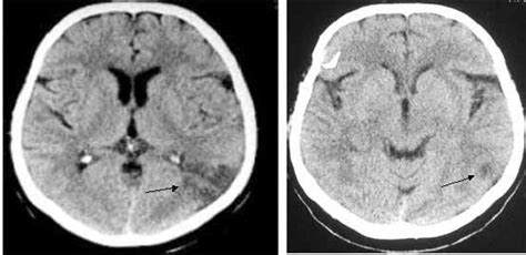 CT scan of brain showed a cortical infarct on left parietal lobe...