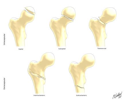 Compound Fracture Left Femur - Foto Kolekcija