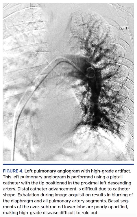 Optimal Technique for Performing Invasive Pulmonary Angiography for Chronic Thromboembolic ...