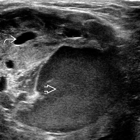 Soft Tissue Sarcoma | Radiology Key