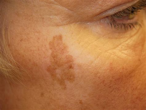 Age spots : Causes, symptoms, and treatment - Richmond Hill Cosmetic Clinic