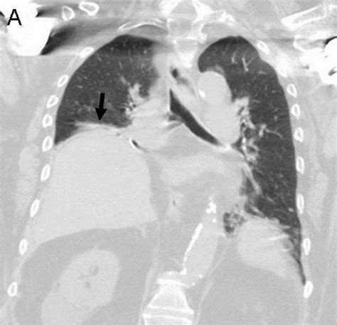 Southwest Journal of Pulmonary, Critical Care and Sleep - Imaging - Medical Image of the Week ...