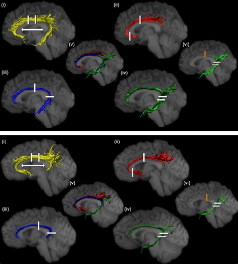 Cingulum reconstructions for two individual participants (upper and... | Download Scientific Diagram