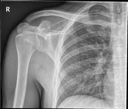 Coracoid Process Of Scapula