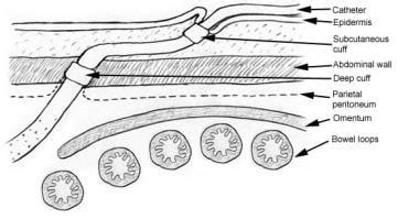 Tenckhoff Peritoneal Dialysis Catheter