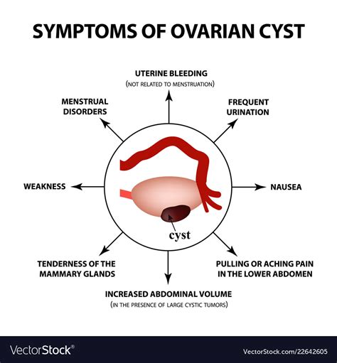 Ovarian Cyst Symptoms