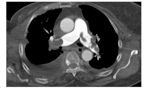 Axial computed tomography pulmonary angiography images in the pulmonary... | Download Scientific ...