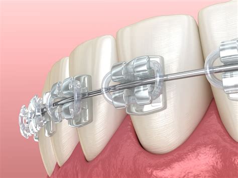 Ceramic Braces Treatment | Lawrenceville, Loganville, Morrow, Stone Mountain, GA