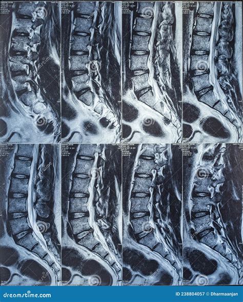 Lumbar Spine Mri Bulging Disc