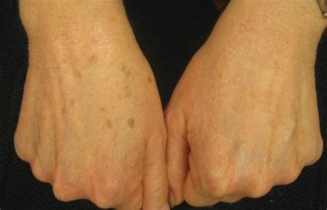 Age Spots on Hands – Causes, Hand Cream Treatment, How to Remove Raised Age Spots on Hands