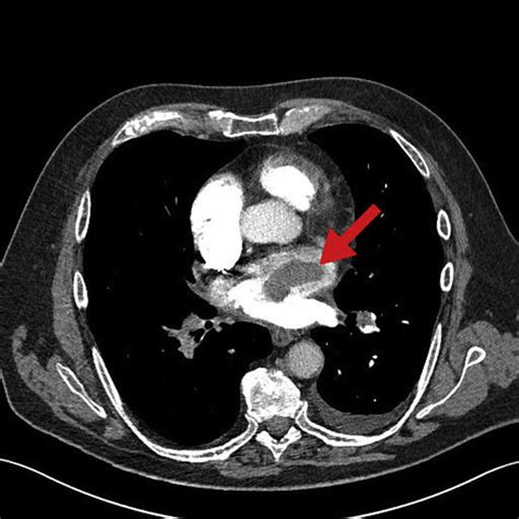 CT pulmonary angiography (CTPA) showinga bilateral pulmonary embolisms... | Download Scientific ...