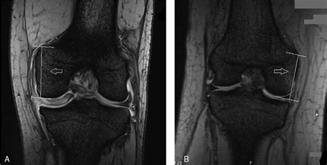 MRI image of the patient (A, left knee) and a normal knee (B, right... | Download Scientific Diagram