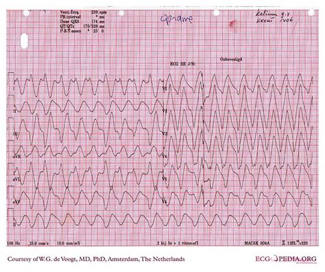 Sine Wave Hyperkalemia Ecg Changes