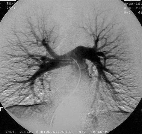 Pulmonary angiography. Causes, symptoms, treatment Pulmonary angiography