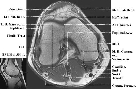 Knee Muscle Anatomy Mri Mri Knee Joint Anatomy Knee Muscle Anatomy | Images and Photos finder