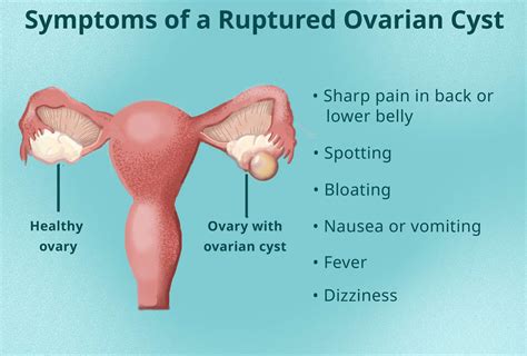 Ovarian Cyst Pain What Does It Really Feel Like?