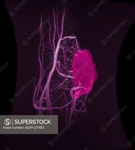 Synovial sarcoma. Sagittal side view MRI of the elbow showing the vascularization of a synovial ...