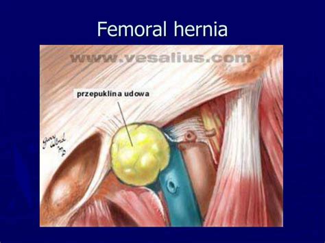 Femoral Hernia Surgery Recovery