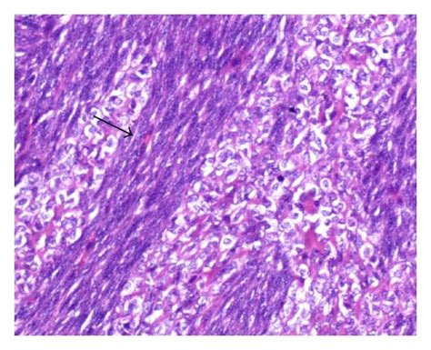 Synovial sarcoma. MRI (of the same patient as Figure 8). On T2W images... | Download Scientific ...