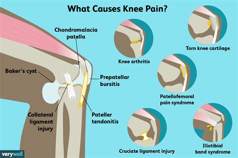 Knee Pain: Causes, Diagnosis, and Treatment