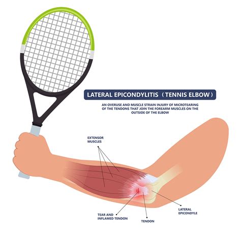 Tennis Elbow (Lateral Epicondylitis): Causes, Symptoms, Treatment