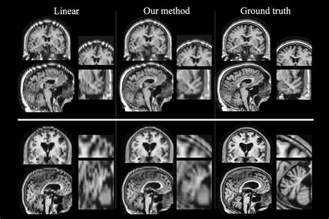 Brain Scans Mri