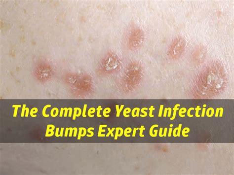 Yeast Fungal Skin Infection : Skin infection pictures and treatments / Sometimes, under certain ...