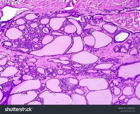 Synovial Sarcoma Histology Image Analyzed By Stock Photo 2238681495 | Shutterstock