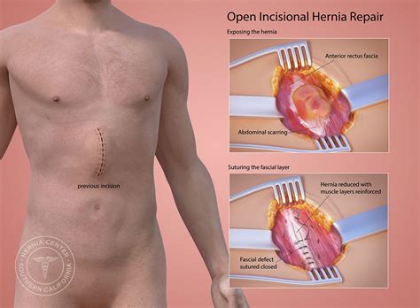 10 Best Clinics for Incisional Hernia Repair in Hungary [2023 Prices]