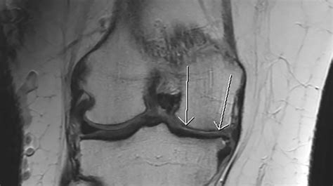 Rheumatoid Arthritis Mri