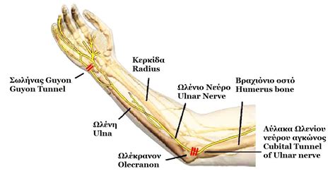 Idiopathic ulnar neuropathy at the elbow - Wikipedia