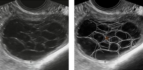 Ovarian Cyst Types Ultrasound