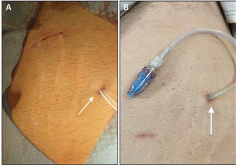 Ten Lessons Learned in Peritoneal Dialysis - Endovascular Today