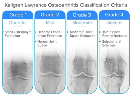 Guide to Severe Knee Arthritis (Tricompartmental Osteoarthritis) - Spring Loaded Technology