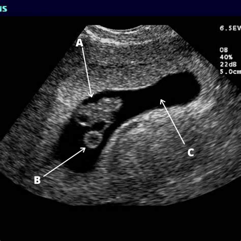 Fetal Pole Diagram