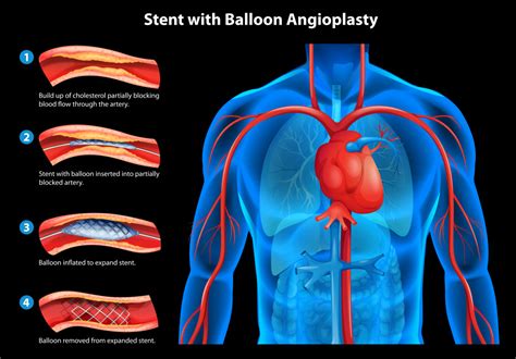 Cardiac Stent Complications: How Many Stents Are Too Many?