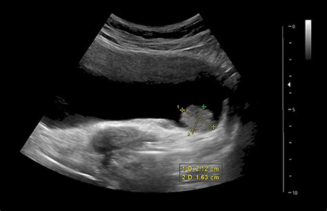 Detecting Bladder Cancer with a CT Scan, Ultrasound or MRI | Cxbladder