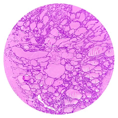 Premium Photo | Synovial sarcoma histology image analyzed by light microscope at histopathology ...