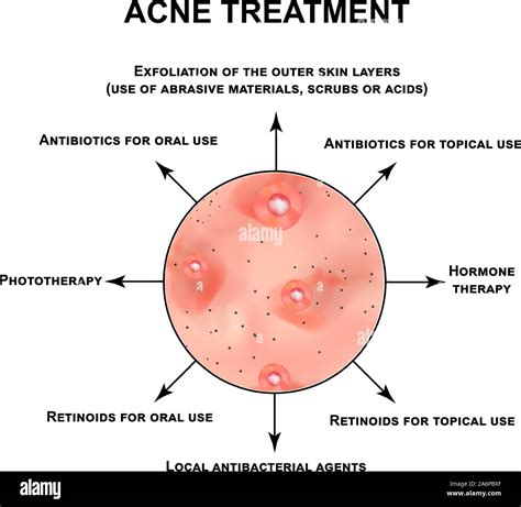 Acne treatment. Pustules, papules, comedones, blackheads, acne on the skin. Infographics. Vector ...