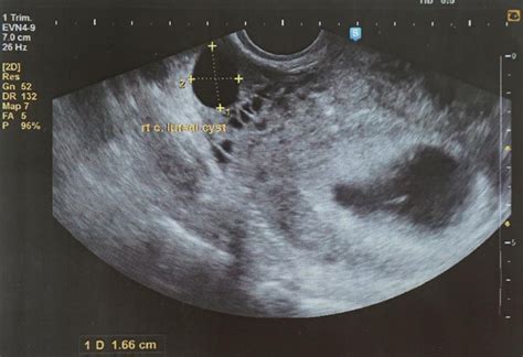 5 Weeks Pregnant Ultrasound Scan