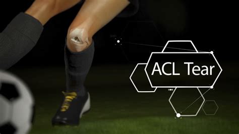 ACL Tear and Injury Management for An Athlete