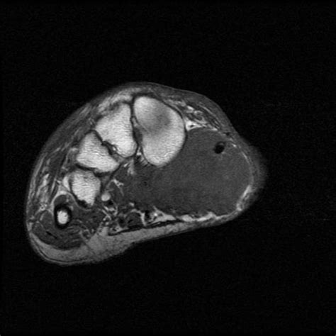 Synovial Sarcoma | The Bone School