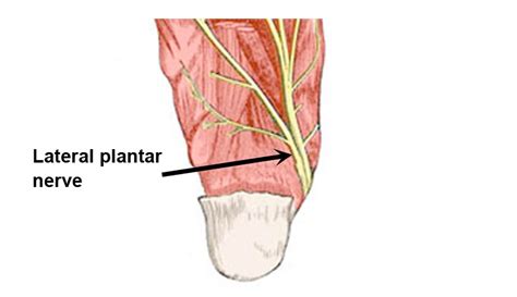 Lateral Plantar Nerve Entrapment - Symptoms, Causes & Treatment