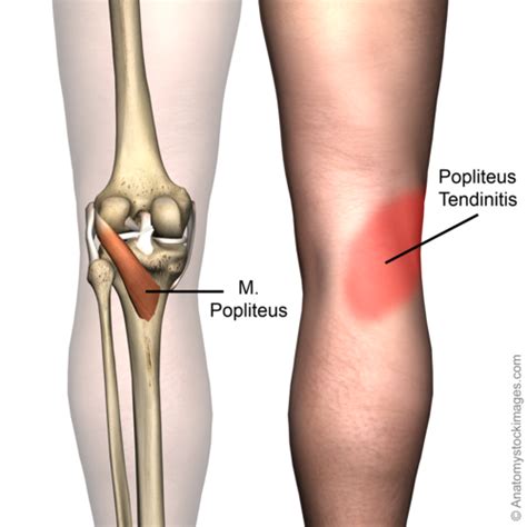 The Popliteus, the Tiny Muscle of Knee Pain!