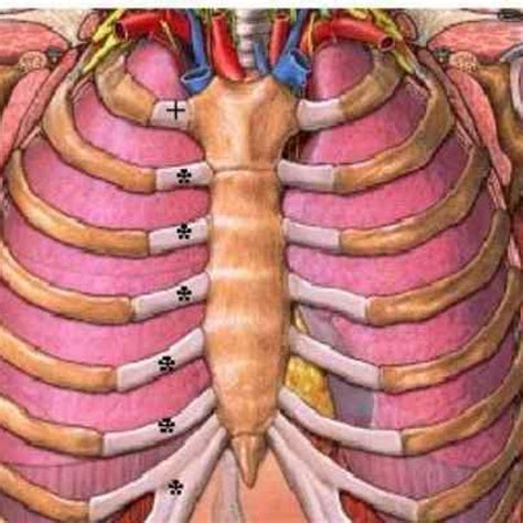 What is Costochondral Separation? | Causes | Symptoms | Treatment – Help Women