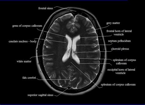 Ct Scan Brain Anatomy : Anatomy Of Head Ct Scan Normal The Brain On Ct And Mri ... / Frontal ...